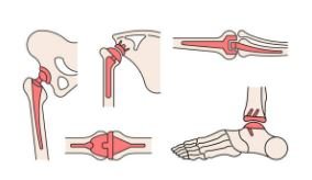 Arthritis and Joint Replacement